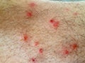 Pimples flea insect man feet