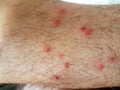 Pimples flea insect man feet