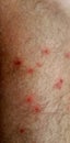 Pimples flea insect man feet