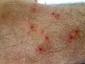 Pimples flea insect man feet