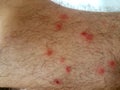 Pimples flea insect man feet