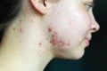 Pimples on the skin of a young girl close-up. Acne on the face of a teenage girl. Problems and treatment of acne in young people. Royalty Free Stock Photo