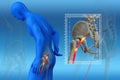 Pinched human sciatic nerve, anatomical vision. 3d illustration