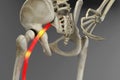 Pinched human sciatic nerve, anatomical vision. 3d illustration