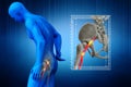 Pinched human sciatic nerve, anatomical vision. 3d illustration