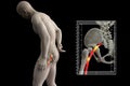 Pinched human sciatic nerve, anatomical vision. 3d illustration