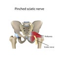Pinched sciatic nerve, vector medical illustration Royalty Free Stock Photo