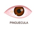 Pinguecula. Conjunctival degeneration. Eye disease. Human organ of vision with pathology. Vector realistic illustration
