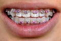 Pink braces Royalty Free Stock Photo