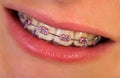 Pink braces