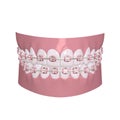 Pink Braces Royalty Free Stock Photo