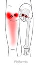 Piriformis trigger points can cause buttocks pain and pain down to the back of thigh to knee, and contribute to sciatica issues