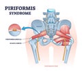 Piriformis syndrome and sciatic nerve compression pain outline diagram Royalty Free Stock Photo