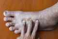 Pitting edema of lower limb. Swollen leg of Asian man