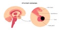 Pituitary adenoma cancer