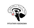 Pituitary adenoma cancer