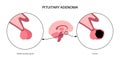 Pituitary adenoma cancer