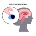 Pituitary adenoma cancer