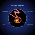 Pituitary adenoma cancer