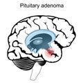 Pituitary adenoma. Cross section of human brain Royalty Free Stock Photo