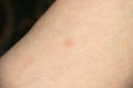 Pityriasis rosea three weeks after the appearance of the first focus on the skin of a young woman. A pink lichen is an approximati Royalty Free Stock Photo