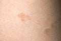 Pityriasis rosea three weeks after the appearance of the first focus on the skin of a young woman. A pink lichen is an approximati