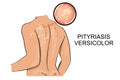 Pityriasis versicolor. dermatology. Royalty Free Stock Photo
