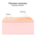 Pityriasis versicolor. fungal skin infection. Cross section of a human skin