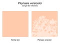 Pityriasis versicolor. fungal skin infection. tinea versicolor Royalty Free Stock Photo