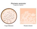 Pityriasis versicolor. skin surface. Malassezia fungi