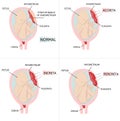 Placenta accreta. Accrete, increta, percreta. colored medical