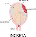 Placenta increta. grades of abnormal attachment illustrated according to the depth Royalty Free Stock Photo