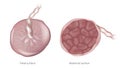 Placenta Maternal surface and Fetal surface. Biology of the Human Placenta Royalty Free Stock Photo