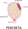 Placenta accreta. grades of abnormal attachment illustrated according to the depth Royalty Free Stock Photo