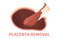 Placenta removal stage of birth via cesarean section