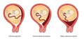 Placement of the placenta