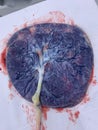 A placenta with an umbilical cord, after birth,. Royalty Free Stock Photo