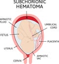 Placental hematoma. blood clots that arise from the placenta Royalty Free Stock Photo