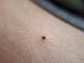 Plague ticks. Lyme disease