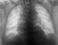 Plain chest radiagraph of patient after cardiac surgery