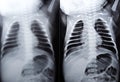 a plain chest x ray for a newborn infant in incubator with a right lung congenital pneumonia at the right apex