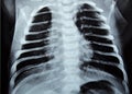 a plain chest x ray for a newborn infant in incubator with a right lung congenital pneumonia at the right apex