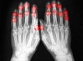 Plain film, radiography, of both hands, arthritis Royalty Free Stock Photo