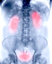 plain kub is x-ray image of urinary system