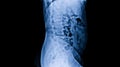 Compression fracture lumbar spine in osteoporosis or osteopenia patient.