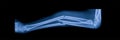 Blue tone of x-ray showed greenstick fracture of both bone forearm.Radius and ulnar Royalty Free Stock Photo