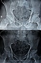 Plain X-ray of both hip joints revealed slight narrowing of superolateral aspect of both hip joints spaces with subchondral