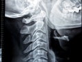 Plain X ray of cervical spine revealed straightened cervical curve, spondylosis osteophytic lipping of C3, C4, C5 vertebral end Royalty Free Stock Photo