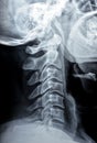 Plain X ray of cervical spine revealed straightened cervical curve, spondylosis osteophytic lipping of C3, C4, C5 vertebral end Royalty Free Stock Photo