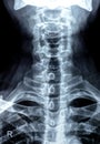 Plain X ray of cervical spine revealed straightened cervical curve, spondylosis osteophytic lipping of C3, C4, C5 vertebral end Royalty Free Stock Photo